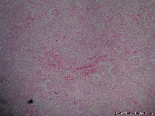 07 1 Hyalinosis renis (Nephrosclerosis arterio-arteriolosclerotica).jpg